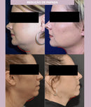 A FaceLift Pro - Máscara de contorno facial - Modela o Rosto, Suaviza Rugas e Papada.
