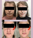 A FaceLift Pro - Máscara de contorno facial - Modela o Rosto, Suaviza Rugas e Papada.